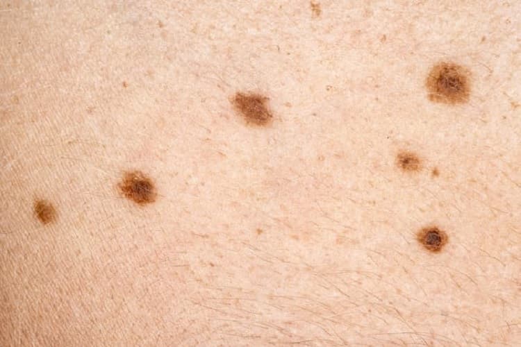 Picture of skin moles from the CDC